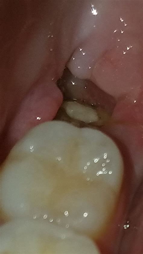 I read some things online and I'm worried I have an abscess. . Acne after wisdom teeth removal reddit
